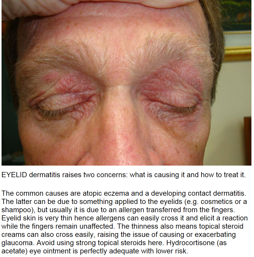 Consultations in Dermatology Eyelid dermatitis