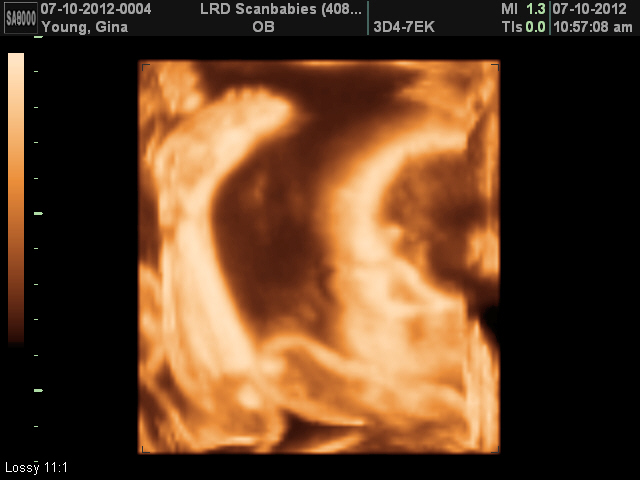 The Young Twin&rsquo;s: 27 Weeks with 3D/4D Ultrasound Pictures