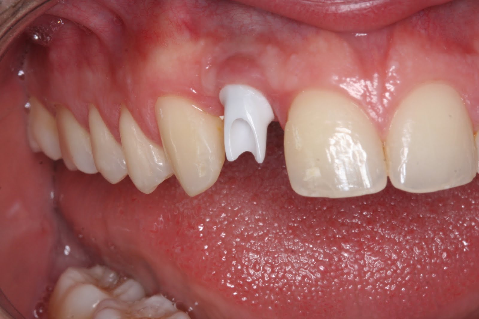 Protético Dentario PRÓTESE SOBRE IMPLANTE METAL FREE ZIRCÓNIA