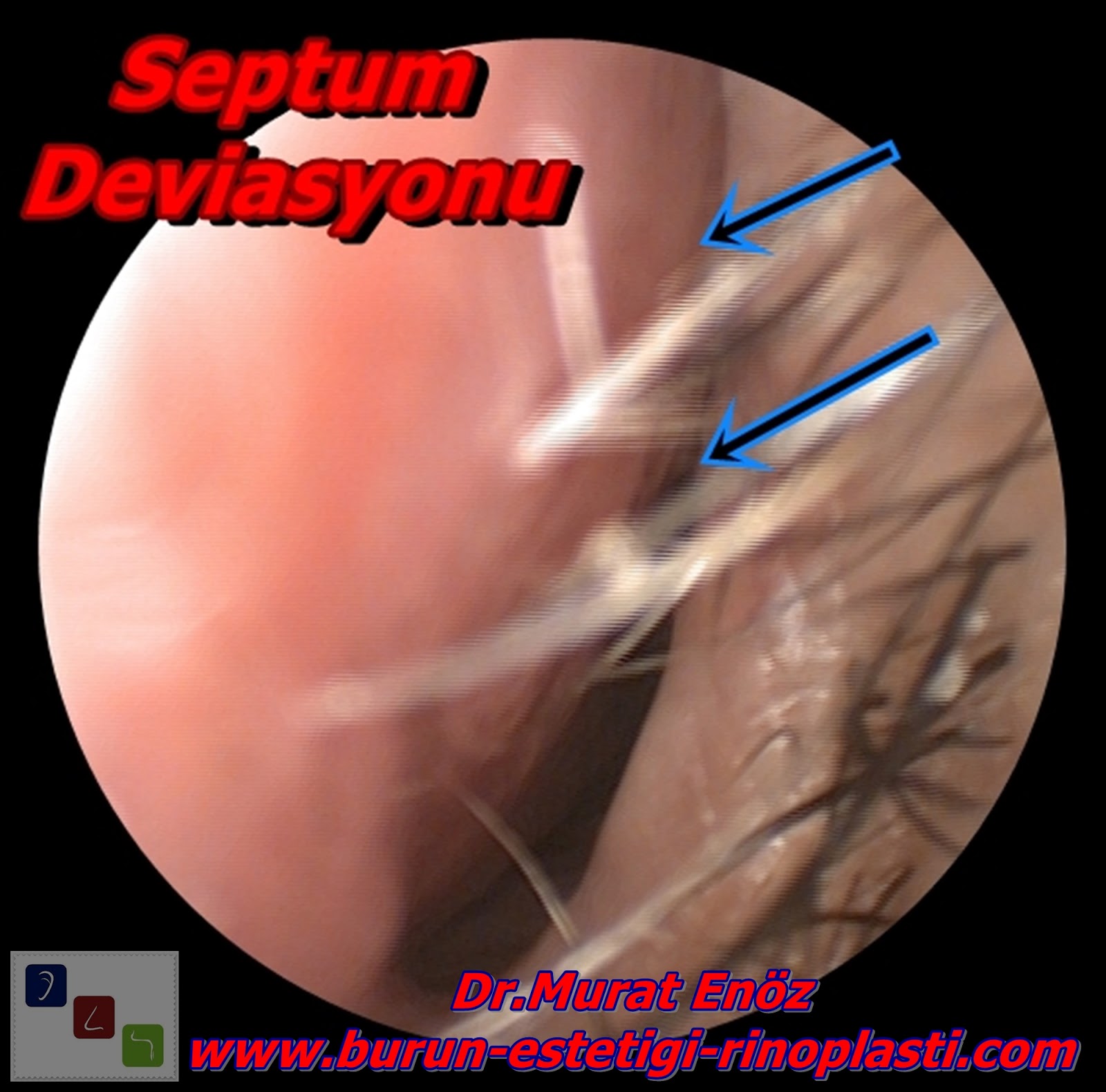 Burun Tıkanıklığı ve Nedenleri