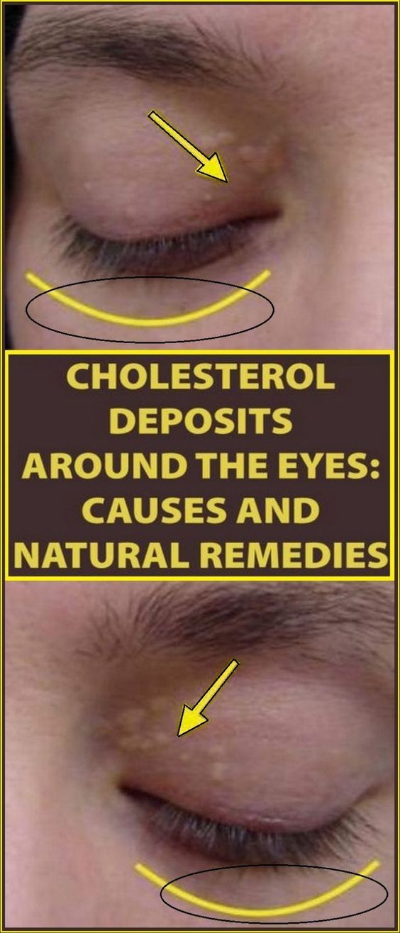 How to Remove the Cholesterol Deposits Around Your Eyes Health