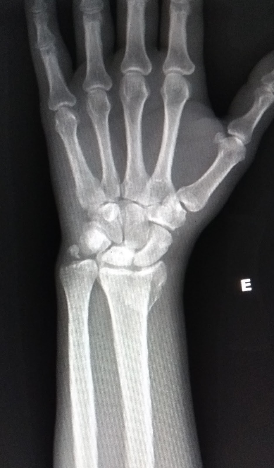 RADIOLOGIA IMAGENS RADIOLÓGICAS FRATURA DISTAL DO RÁDIO FRATURA DE SMITH RADIOLOGIA IMAGENS RADIOLÓGICAS FRATURA DISTAL DO RÁDIO FRATURA DE SMITH