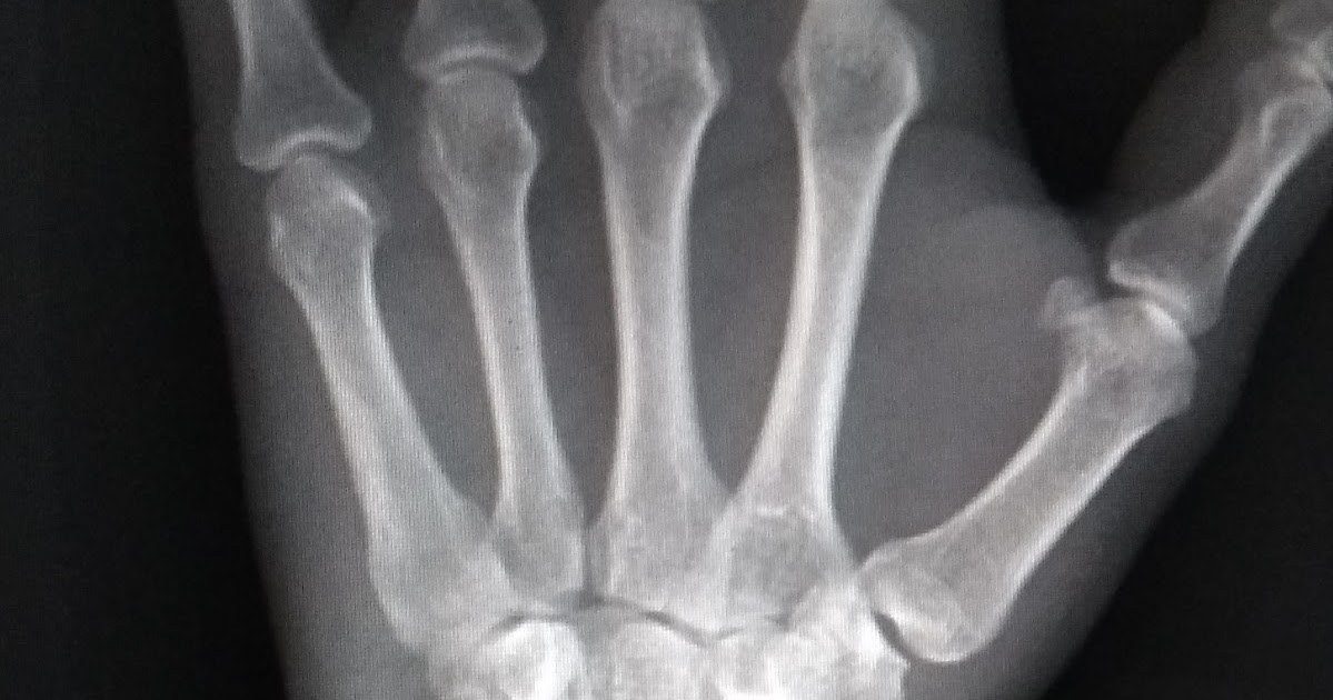 RADIOLOGIA IMAGENS RADIOLÓGICAS FRATURA DISTAL DO RÁDIO FRATURA DE SMITH RADIOLOGIA IMAGENS RADIOLÓGICAS FRATURA DISTAL DO RÁDIO FRATURA DE SMITH