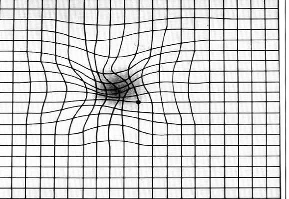 amsler grid in macular degeneration