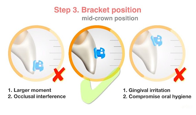 DIGITAL ORTHODONTICS: Occlusion, Overcorrection and Bracket Position (Part 2) - Dr. Chris Chang