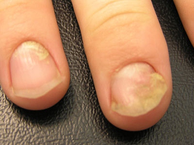 Nail psoriasis: Can treatment or home care help? - Mayo Clinic