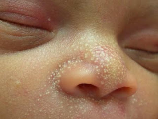 Pimple on Newborn Babies Pimple on Newborn Babies