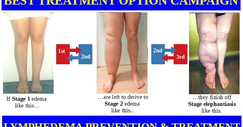 Asociacion Galega De Linfedema Lipedema Insuficiencia Venosa