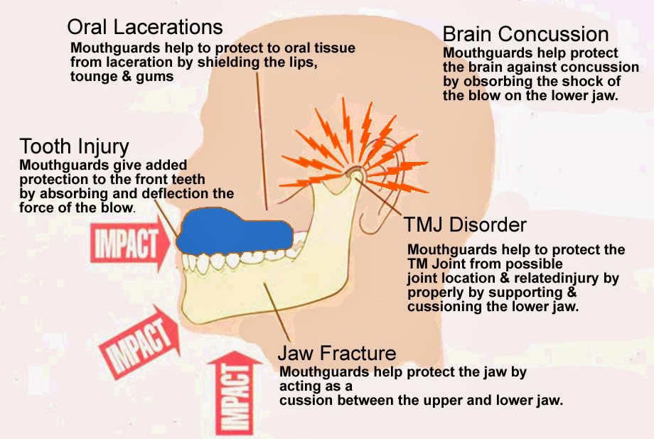 Click N' Fit Custom Mouthguards Safety and Protection