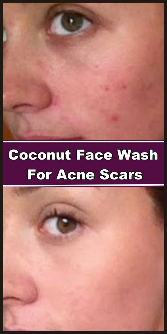 Coconut Face Wash For Acne Scars beauty4everything3