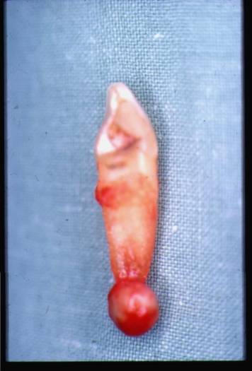 extraction dent abces extraction dent abces