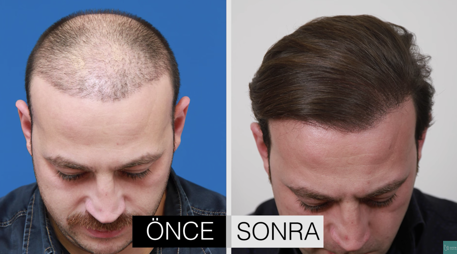 Мужчина после ковида. Мужчины после пересадки волос. Стрижка после пересадки волос. Пересаженные волосы на голове. Стамбул трансплантация волос мужчины.