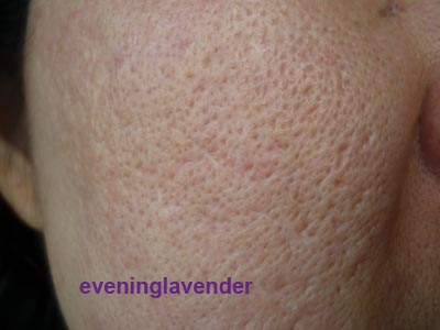 pmd microderm before and after pmd microderm before and after