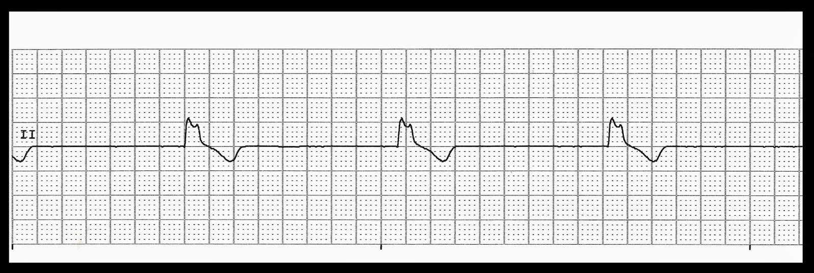 EKG Rhythm Quiz 263