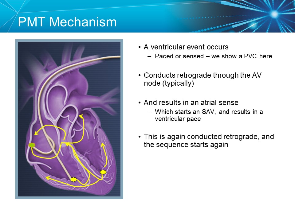 CVT Mohd Farid: Basic Pacemaker Troubleshooting Part II-Medtronic Academy