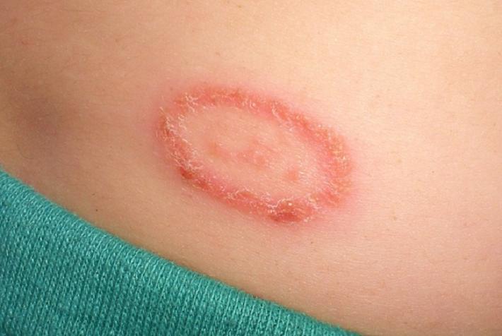 Are ringworms contagious? - Health Care Tips and Natural Remedies
