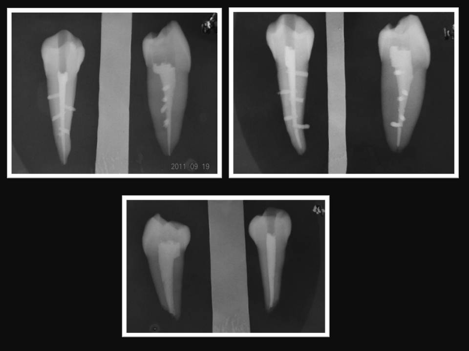 ENDODONCIA Casos Clínicos CALAMUS DUAL + CASO CLINICO