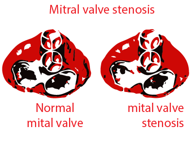 Mitral valve stenosis