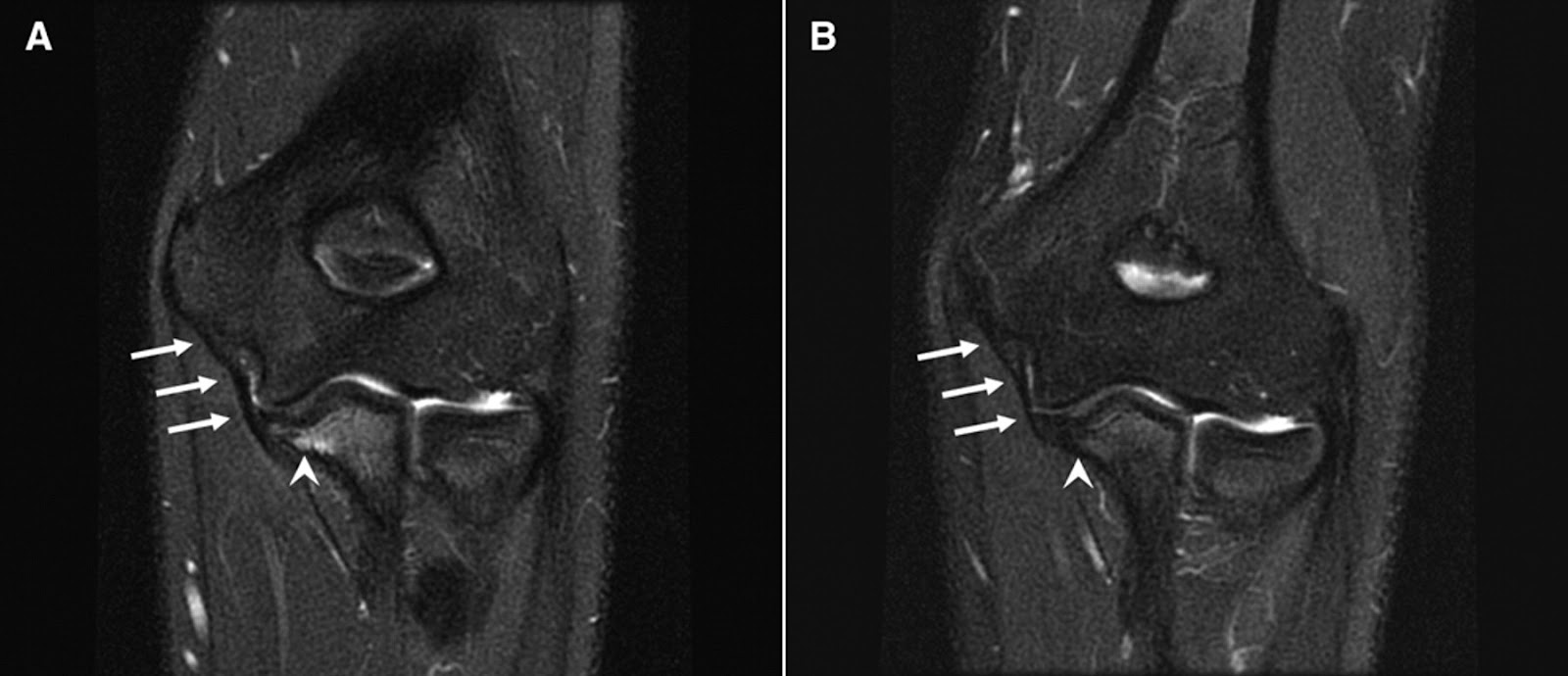 MRI MusculoSkeletal Section Ulnar Collateral Ligament