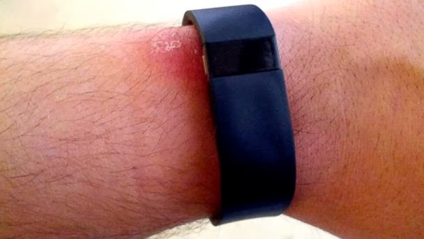 Fitness Tech M.D. by @DrJosephKim: Is your Fitbit Force giving you a rash?