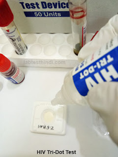 HIV test - Add 5 drop buffer solution