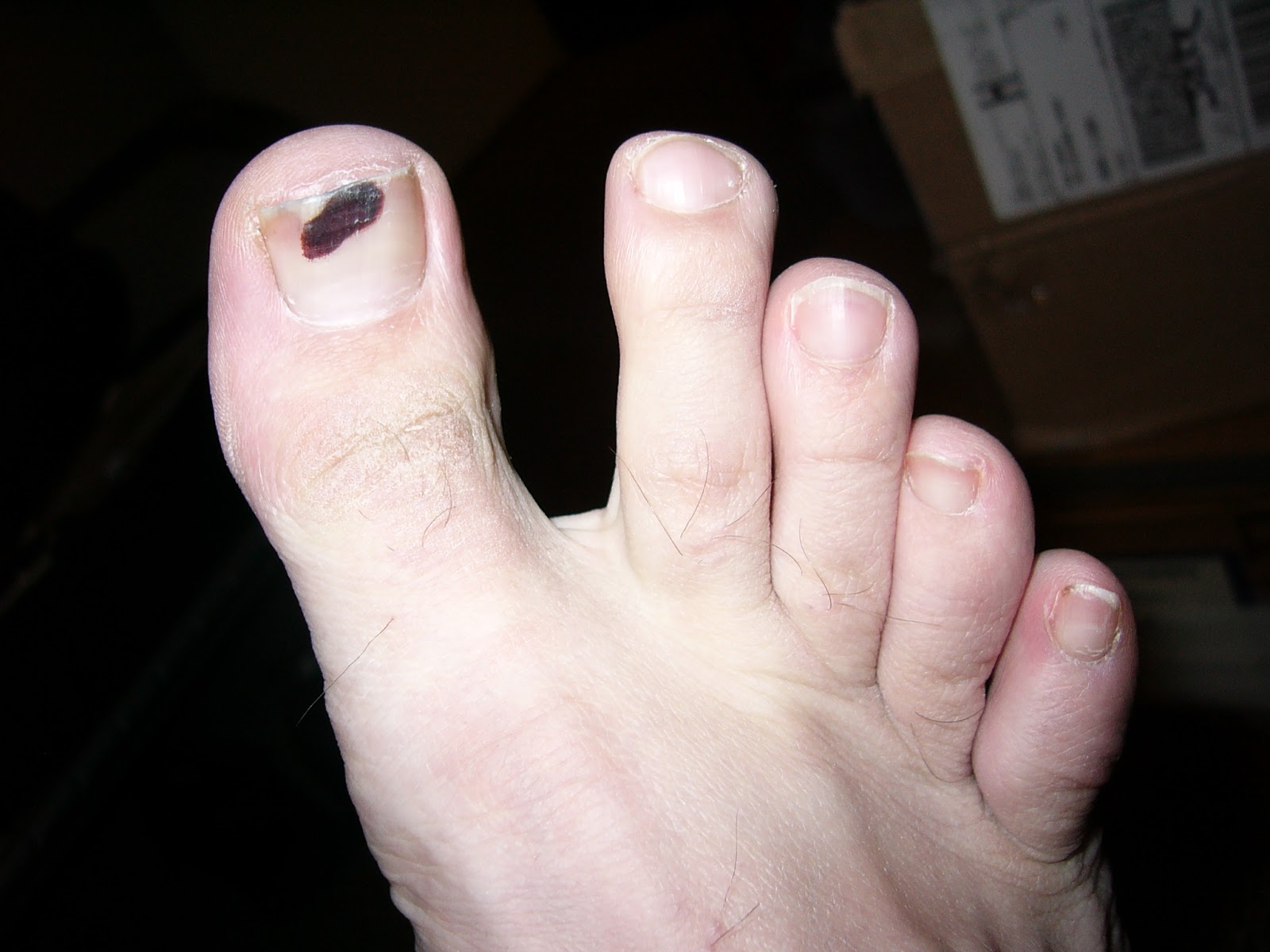 jake-sharon-blood-blister-cause-i-m-clumsy
