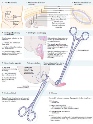 Dr Mat: Appendectomy is the surgical removal of the appendix, typically ...