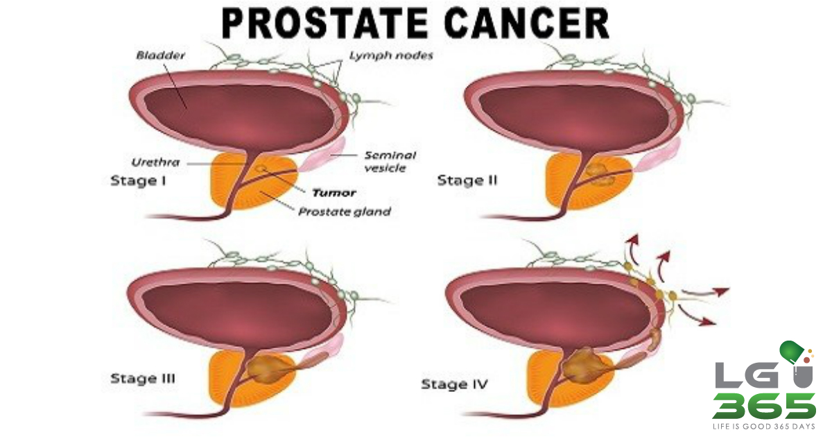 When prostate cancer spreads to lymph nodes