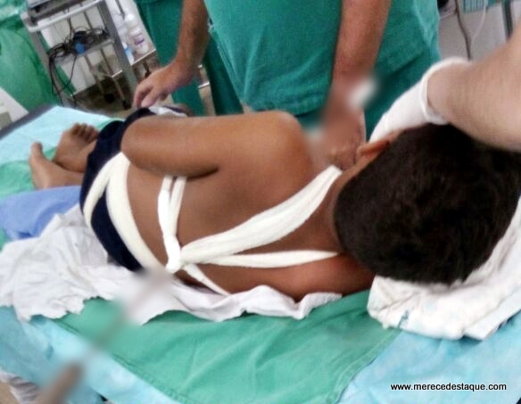 Garoto de 11 anos cai sobre espeto de ferro que atravessa seu corpo, em Toritama