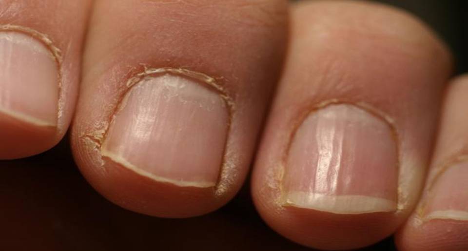 Red Alert If You See This On Your Nails Immediately Visit