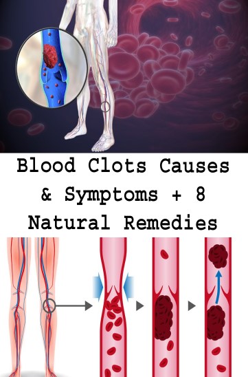 Blood Clots Causes And Symptoms 8 Natural Remedies