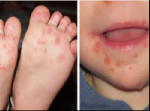 √ New Disease Is Rapidly Spreading Among Children: Experts Warn Parents