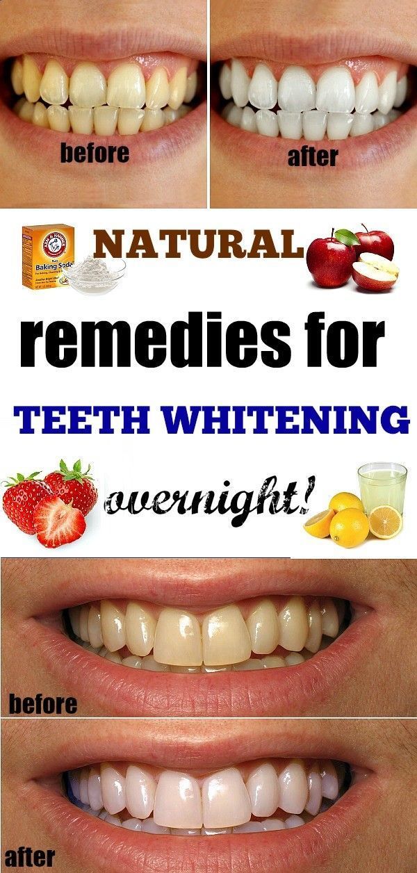 Home Remedies for Teeth Whitening