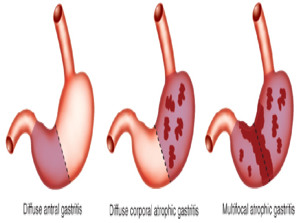 Penyakit Gastritis Peradangan Lambung Maag
