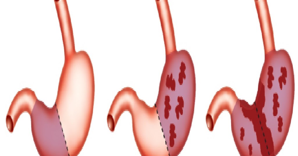 Penyakit Gastritis Peradangan Lambung Maag