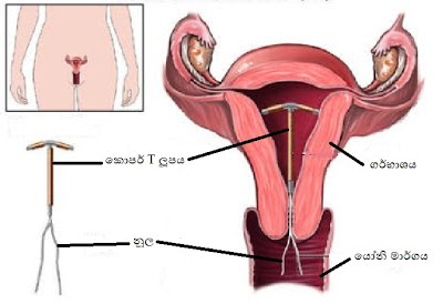 si55551653_IUD+Insertion.jpg