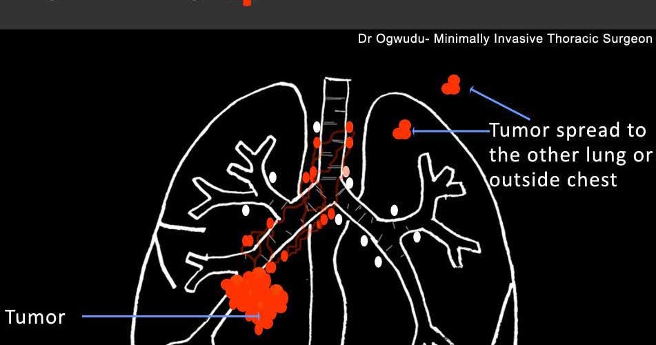 Stage 4 Lung Cancer How Long To Live