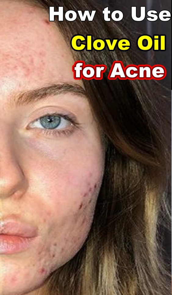How to Use Clove Oil for Acne ? beauty4everything3