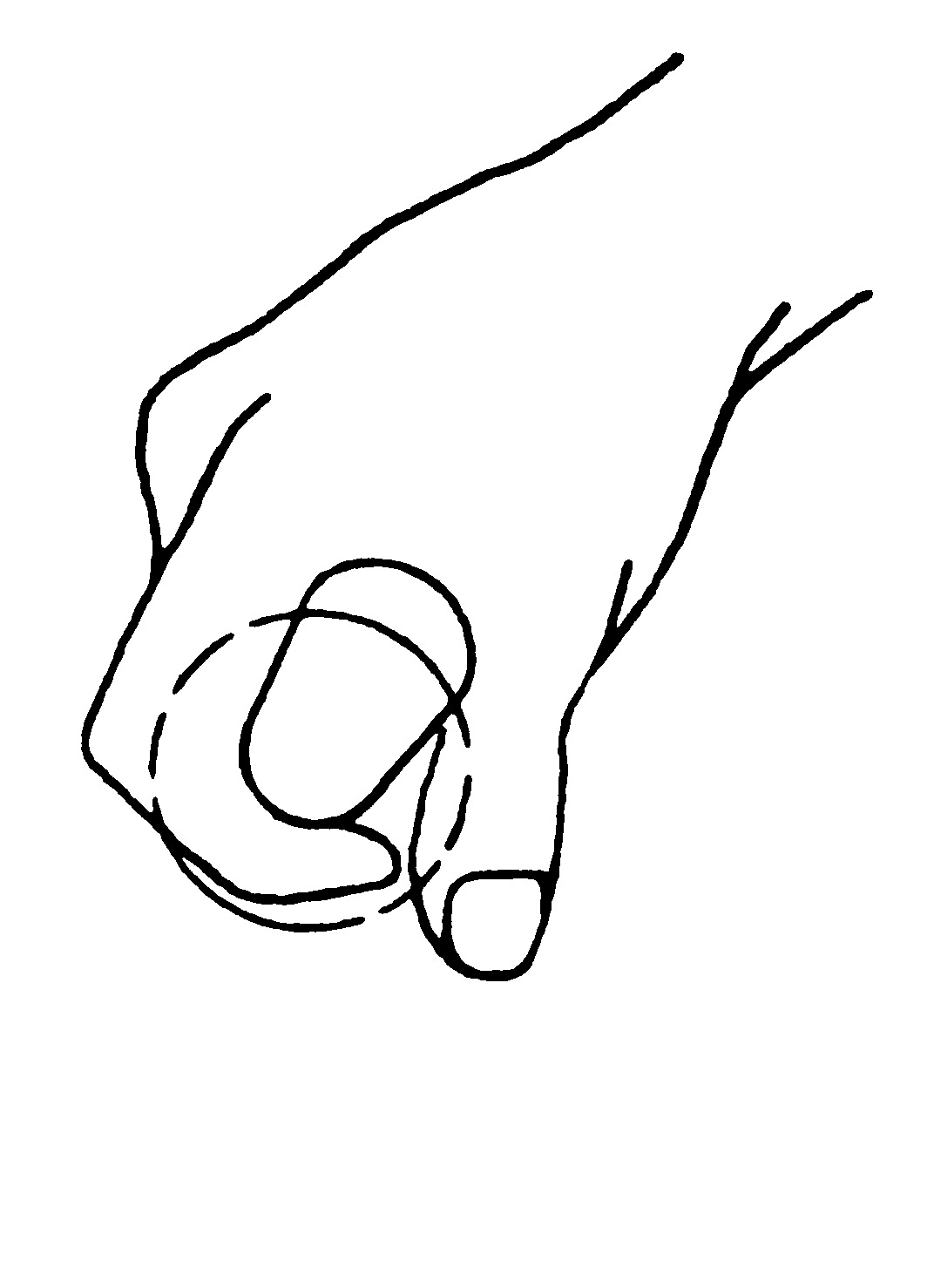 Rimec S.r.l. Oscillating saw injuries during plaster cast removal