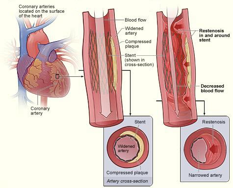 Cardiac Stent