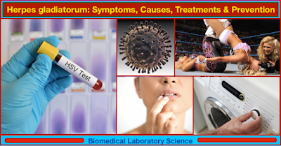 Herpes Gladiatorum Facts Symptoms Causes Risk