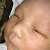 Mata Bayi Ini Buta Karena Flash Kamera