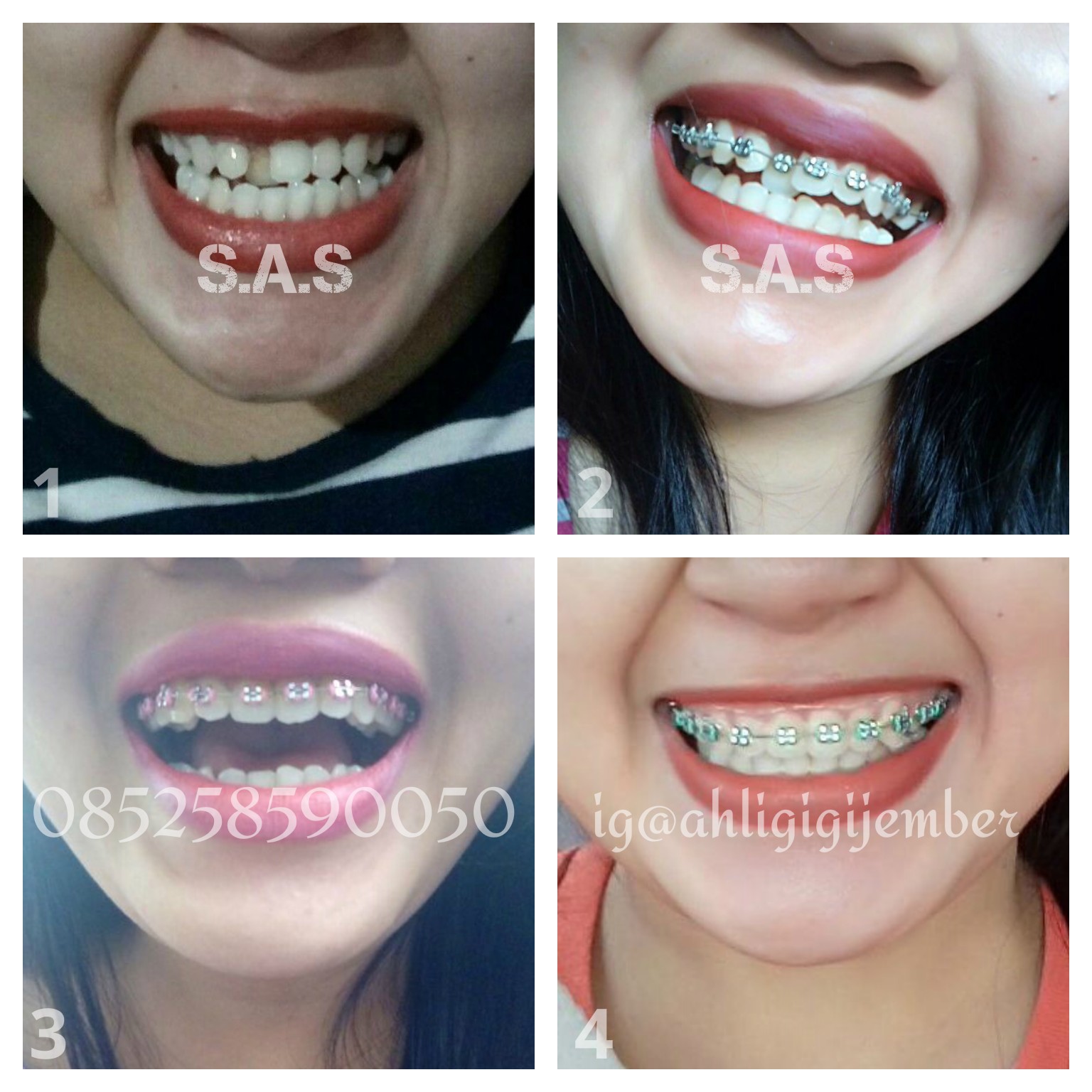 Perpaduan Warna Karet Behel Yang Bagus