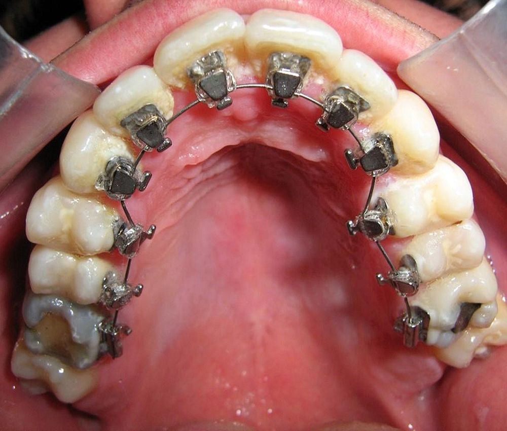 ORTODONCIA Lingual Colocación de brackets paso a paso OdontoVida