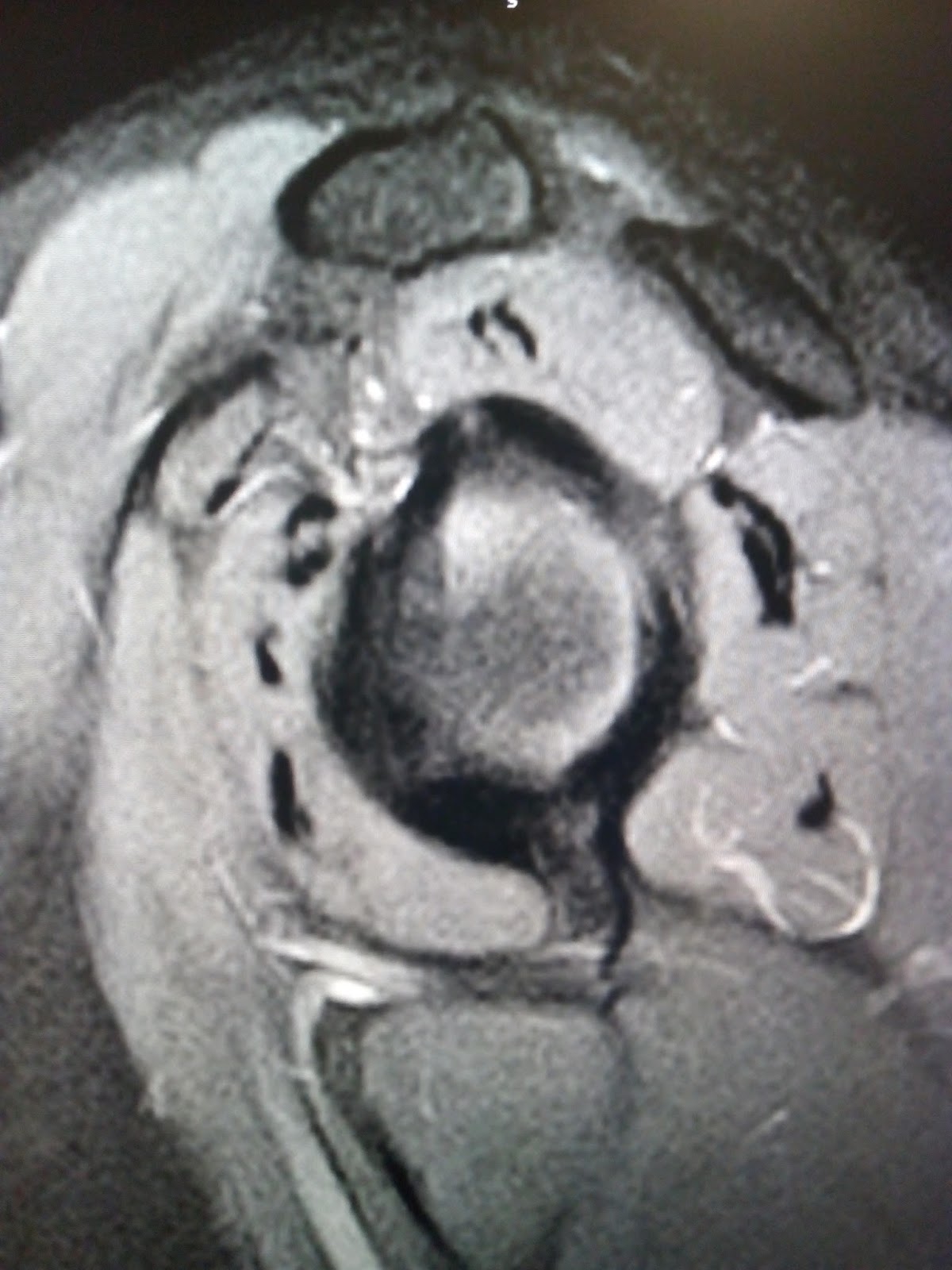 Adhesive capsulitisMRI Sumer's Radiology Blog