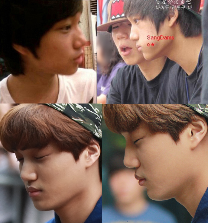 얼굴 부어서 한쪽 쌍커풀라인 사라진 엑소 카이 | 인스티즈