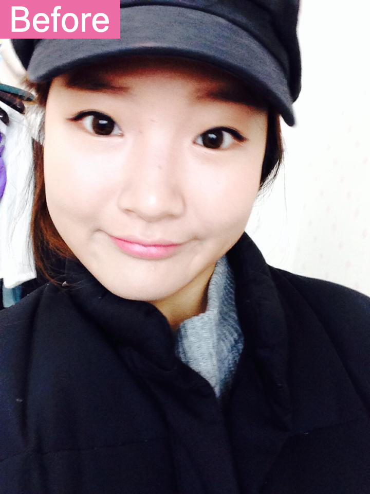 [ID Hospital Review] Rhinoplasty & double eyelid surgery review, Korean plastic surgery before