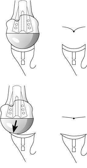 Shoulder Arthritis Rotator Cuff Tears Causes Of