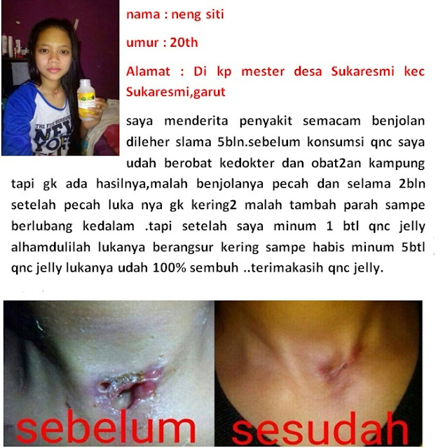 Image result for Testi Qnc jelly gamat kanker nasofaring