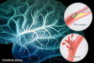 Kehilangan kemampuan motorik pada bagian tubuh tertentu akibat stroke